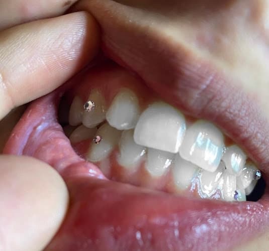 Hollywood Smiles409 Cosmetic Teeth Whitening